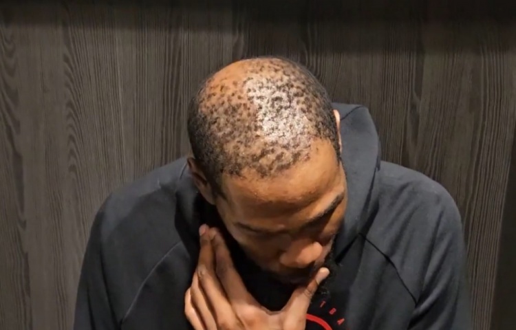 云开体育官网入口-37岁还单身有原因😳！杜兰特秃顶这么严重 这发量找对象难啊